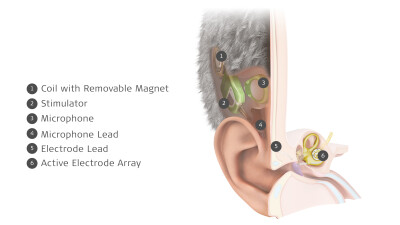 MED-EL Launches World’s First Commercially Available  Totally Invisible Cochlear Implant