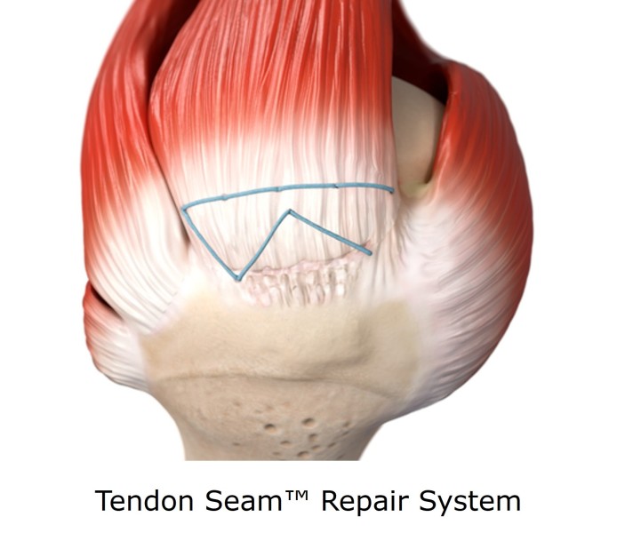 Smith+Nephew to feature leading rotator cuff repair portfolio including new Tendon Seam™ Repair System and REGENETEN◊ Bioinductive Implant at AAOS 2026