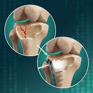 Biomimetic Innovations Ltd Announces Upcoming Clinical Study of OsStic™ Injectable Synthetic Bone Void Filler in Tibial Plateau Fracture Fixation